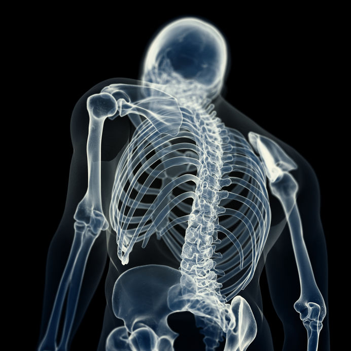 Osteoma osteoide na coluna: sintomas, causas e tratamentos - Cirurgião da  Coluna Vertebral em Cuiabá | Dr. Carlos Augusto Costa Marques