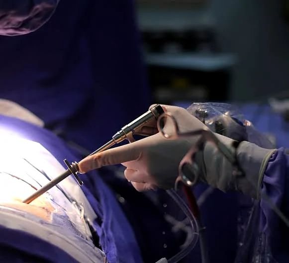 Endoscópio e instrumental sendo usados em uma cirurgia endoscópica da coluna