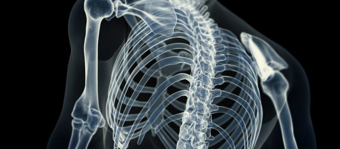 osteoma osteoide columna vertebral